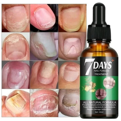 Sérum naturel - Traitement des mycoses des ongles