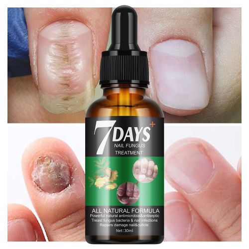 Sérum naturel - Traitement des mycoses des ongles