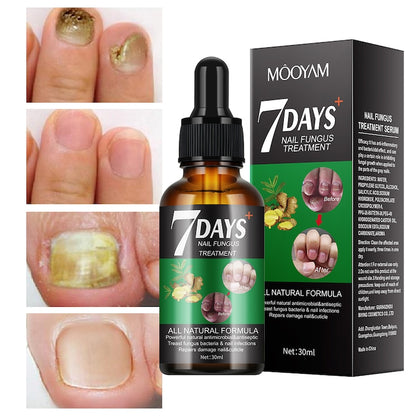 Sérum naturel - Traitement des mycoses des ongles
