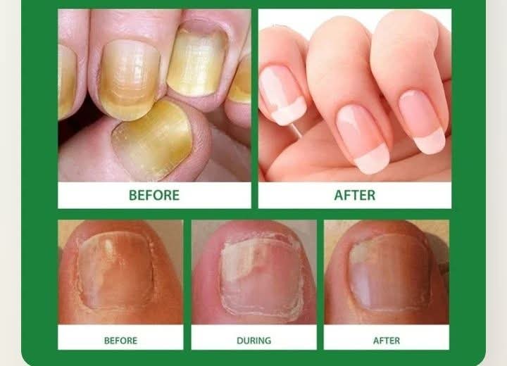 Sérum naturel - Traitement des mycoses des ongles